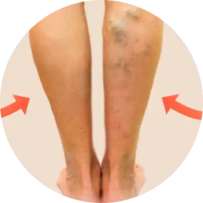  Varicose Veins Remedy